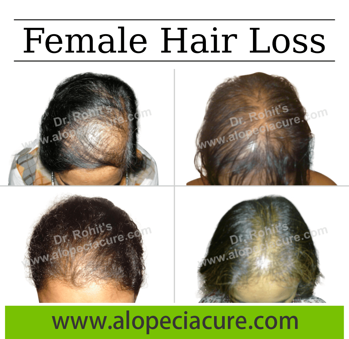 female hair loss